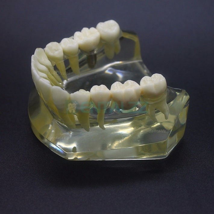Badanie implantów dentystycznych Model Typodont Most korony dolnej szczęki 2010