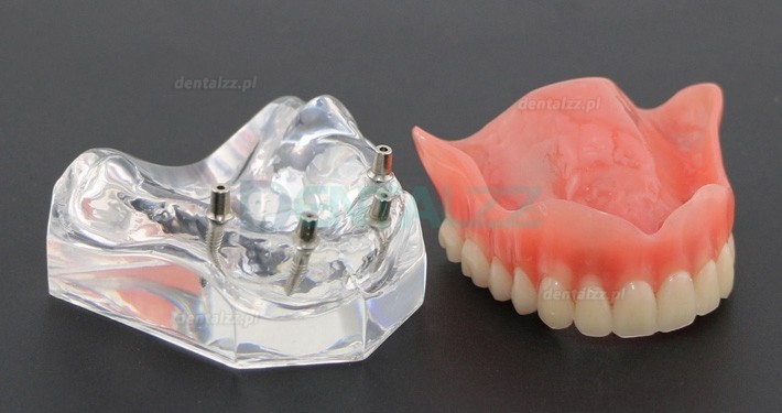 Badanie dentystyczne Model zębów Overdenture Superior z 4 implantami Model demonstracyjny 6001