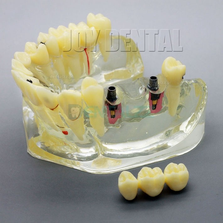 2 Razy powiększony model badania odbudowy zębów/protezy/implantu z mostem