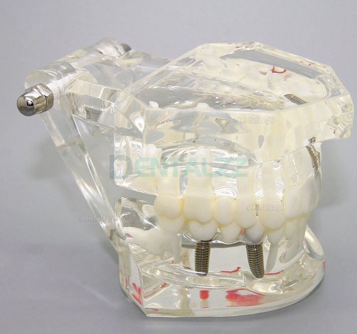 Analiza badania implantów dentystycznych Demonstracja modelu choroby zębów z odbudową M2001