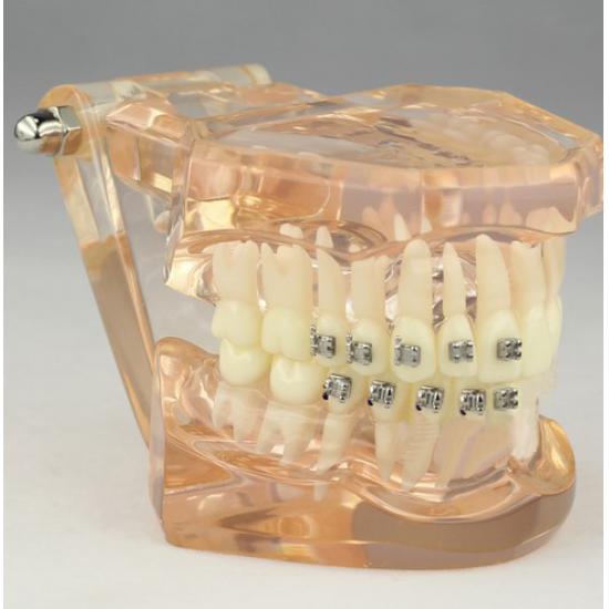 Model dentystyczny ortodontyczny z zamkami ceramicznymi M3009