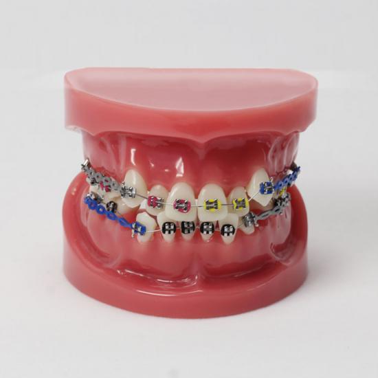 Korekcja wad zgryzu zębów dentystycznych za pomocą wspornika zębów Standardowy model M3005