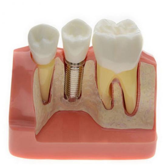 Analiza modelu implantu dentystycznego M2017