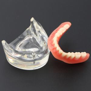 Model zębów dentystycznych Overdenture Inferor z 2 implantami Badanie modelu dem...