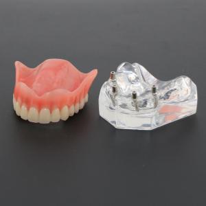 Badanie dentystyczne Model zębów Overdenture Superior z 4 implantami Model demon...