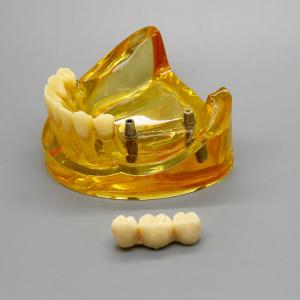 Model implantu dentystycznego dolnej szczęki z 2 implantami mostów 2011