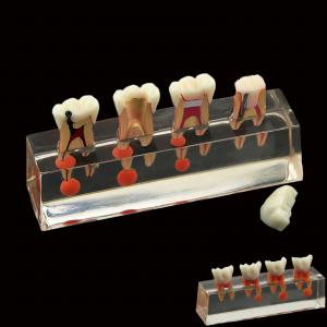 Model zębów dentystycznych 4-etapowe leczenie endodontyczne wykazuje anatomiczny...