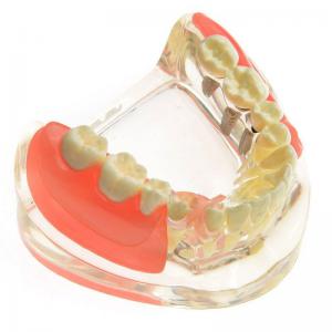 Odbudowa brakujących zębów trzonowych na modelach dentystycznych M-6006