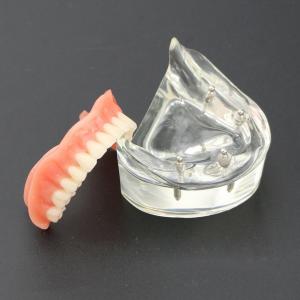 Model badania dentystycznego zębów dolnych 6002 02 Implanty Overdenture Inferior...