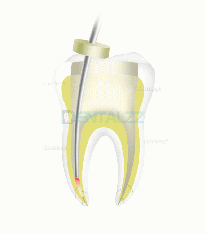 Woodpecker Fi-P Bezprzewodowy dentystyczny długopis do obturacji endo z gutaperką