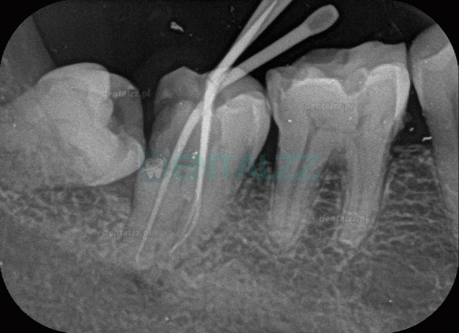 Fussen F200 Skaner płyt fosforowych skaner PSP do obrazowania rentgenowskiego dentystycznego