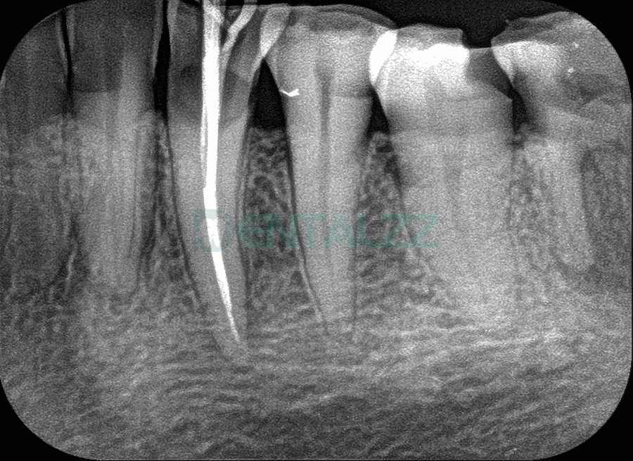 Fussen F200 Skaner płyt fosforowych skaner PSP do obrazowania rentgenowskiego dentystycznego