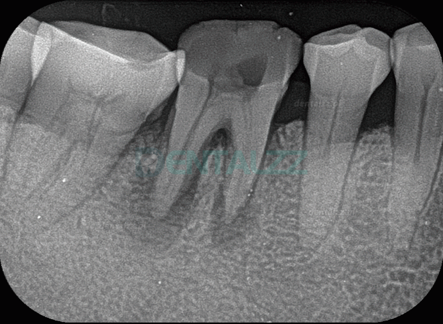 Fussen F200 Skaner płyt fosforowych skaner PSP do obrazowania rentgenowskiego dentystycznego