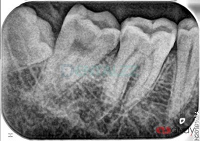 Handy HDS-500 Skaner płyt fosforowych PSP cyfrowy skaner płytek fosforowych do obrazowania dentystycznego