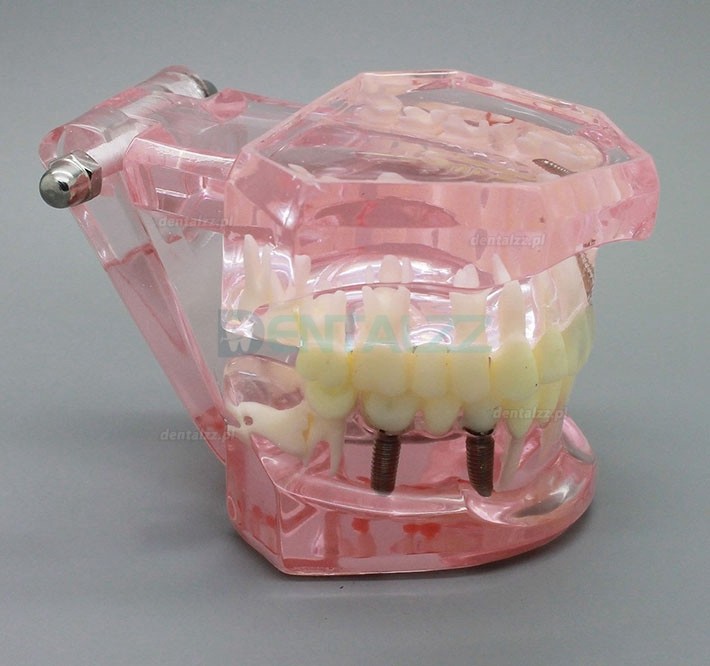 Analiza badania implantów dentystycznych Demonstracyjny model zębów z odbudową 2001