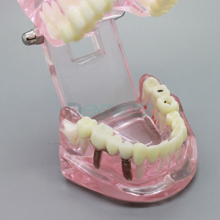 Analiza badania implantów dentystycznych Demonstracyjny model zębów z odbudową 2001