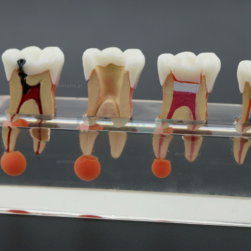 Model zębów dentystycznych 4-etapowe leczenie endodontyczne wykazuje anatomiczny charakter M4018-01