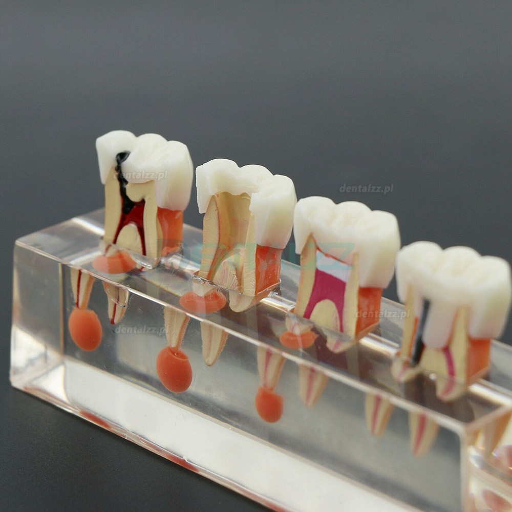 Model zębów dentystycznych 4-etapowe leczenie endodontyczne wykazuje anatomiczny charakter M4018-01