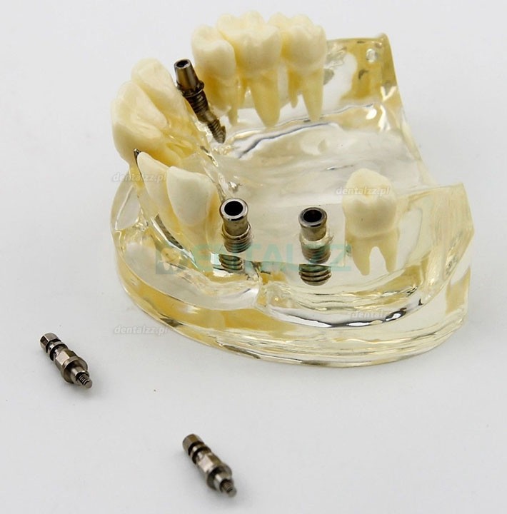 Badanie Chirurgii Implantów Górnej Szczęki Dentystycznej Model Dem 2005