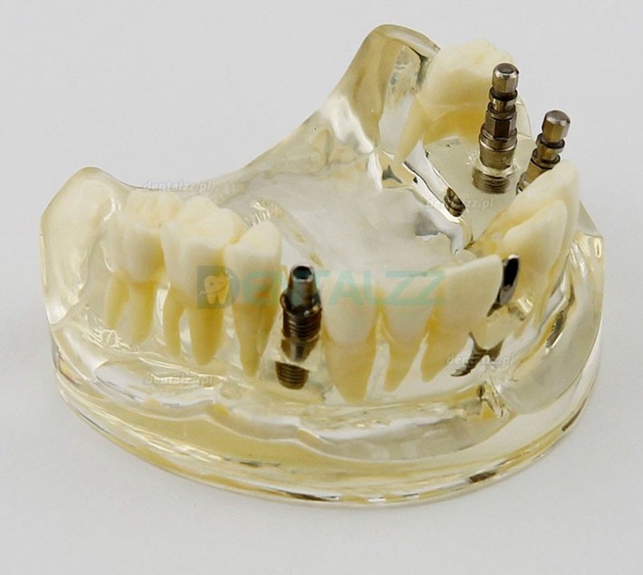 Badanie Chirurgii Implantów Górnej Szczęki Dentystycznej Model Dem 2005