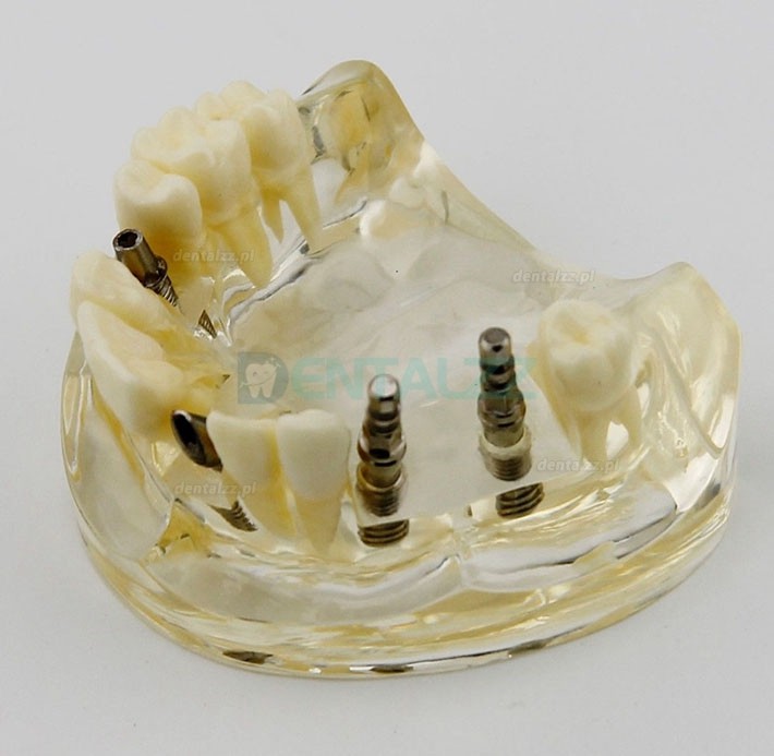 Badanie Chirurgii Implantów Górnej Szczęki Dentystycznej Model Dem 2005