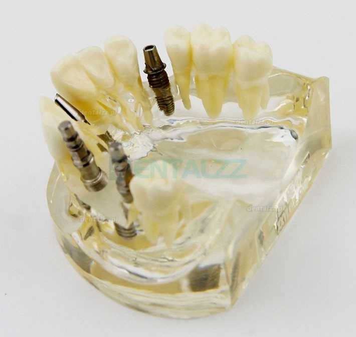 Badanie Chirurgii Implantów Górnej Szczęki Dentystycznej Model Dem 2005