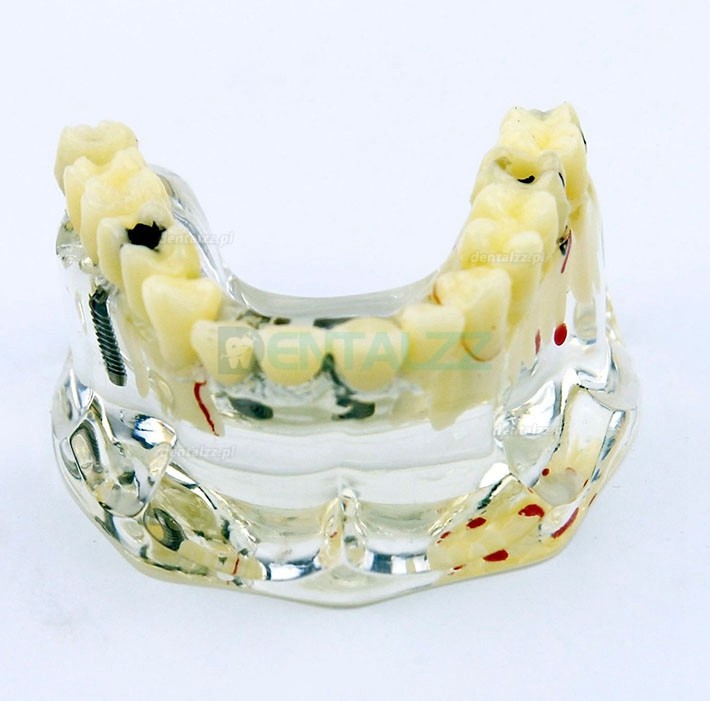 Model implantu dentystycznego górnej szczęki z mostem i próchnicą -I 2006