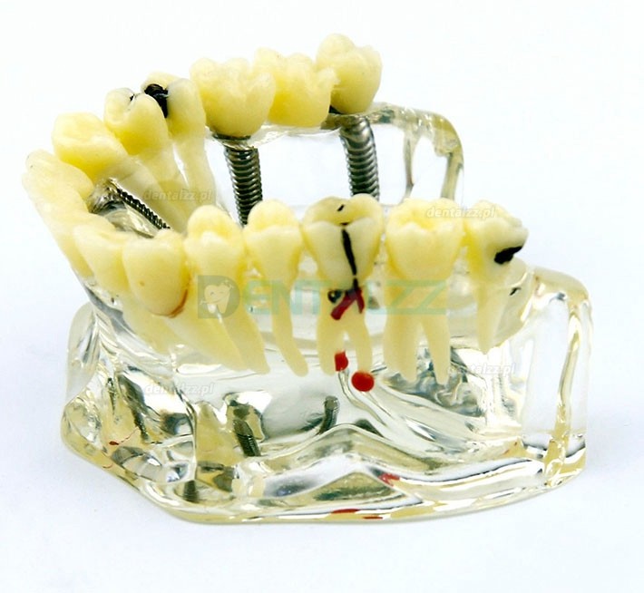 Model implantu dentystycznego górnej szczęki z mostem i próchnicą -I 2006
