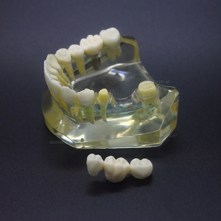 Badanie implantów dentystycznych Model Typodont Most korony dolnej szczęki 2010