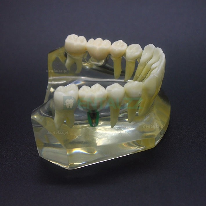 Badanie implantów dentystycznych Model Typodont Most korony dolnej szczęki 2010