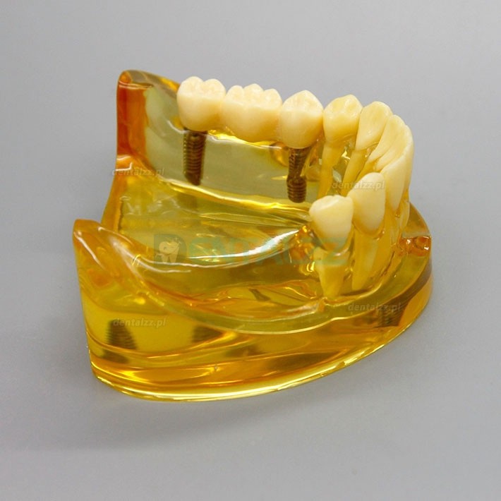 Model implantu dentystycznego dolnej szczęki z 2 implantami mostów 2011