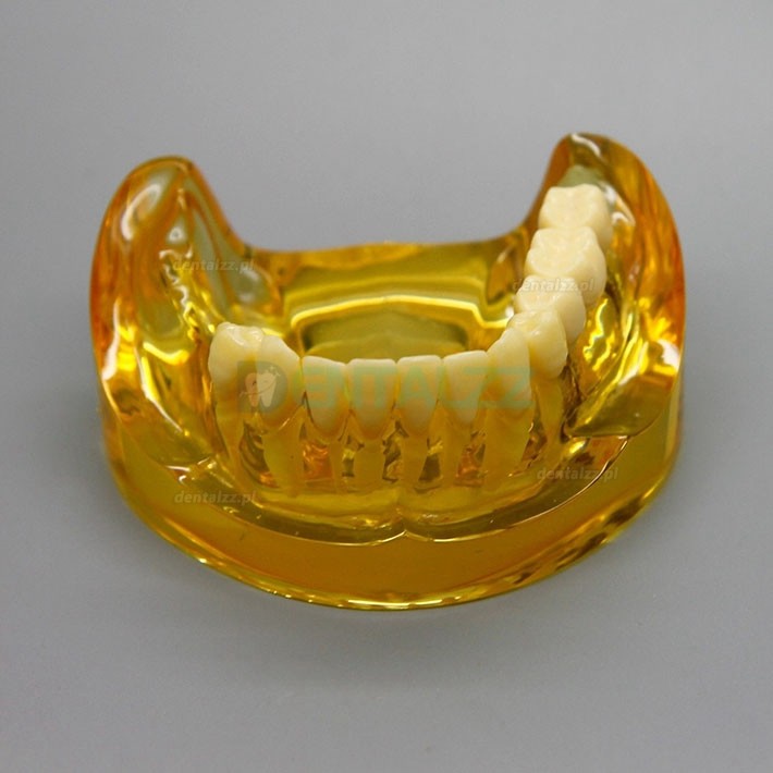 Model implantu dentystycznego dolnej szczęki z 2 implantami mostów 2011