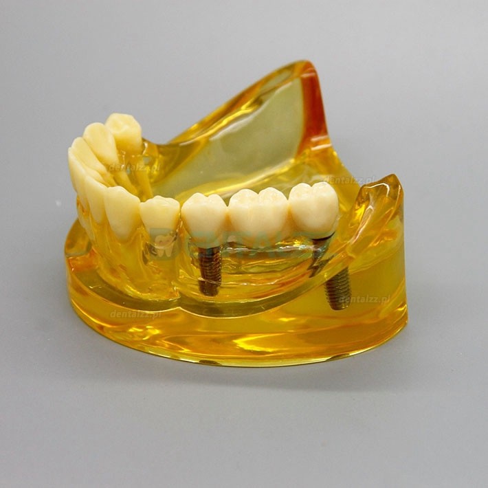 Model implantu dentystycznego dolnej szczęki z 2 implantami mostów 2011