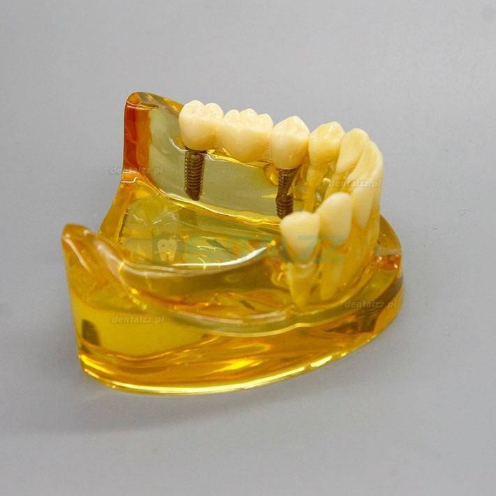 Model implantu dentystycznego dolnej szczęki z 2 implantami mostów 2011
