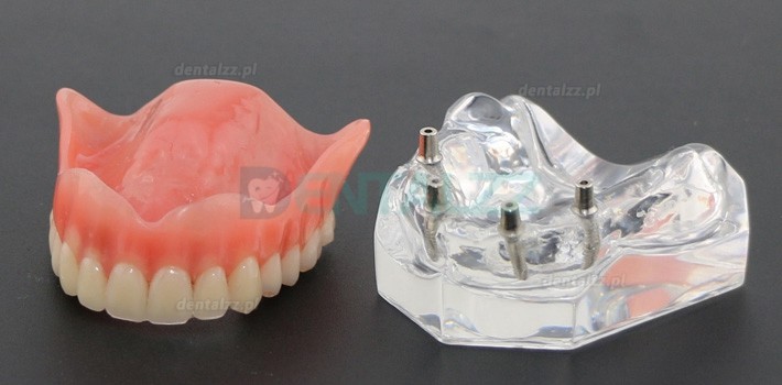 Badanie dentystyczne Model zębów Overdenture Superior z 4 implantami Model demonstracyjny 6001