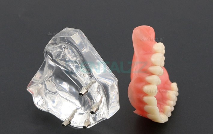 Badanie dentystyczne Model zębów Overdenture Superior z 4 implantami Model demonstracyjny 6001