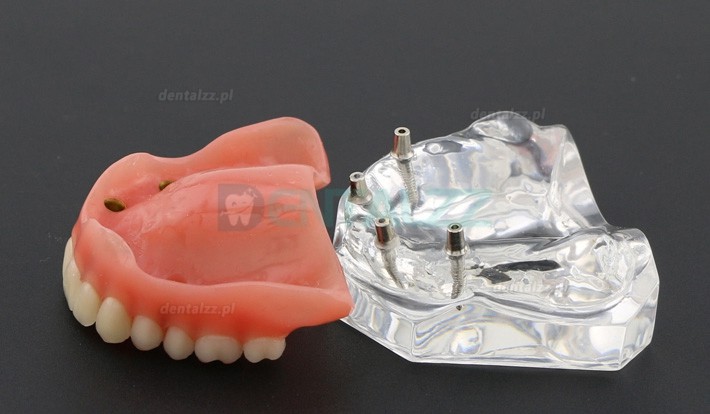 Badanie dentystyczne Model zębów Overdenture Superior z 4 implantami Model demonstracyjny 6001