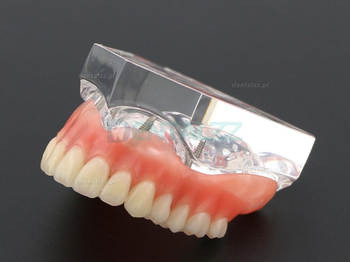 Badanie dentystyczne Model zębów Overdenture Superior z 4 implantami Model demonstracyjny 6001