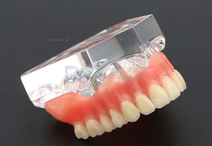 Badanie dentystyczne Model zębów Overdenture Superior z 4 implantami Model demonstracyjny 6001