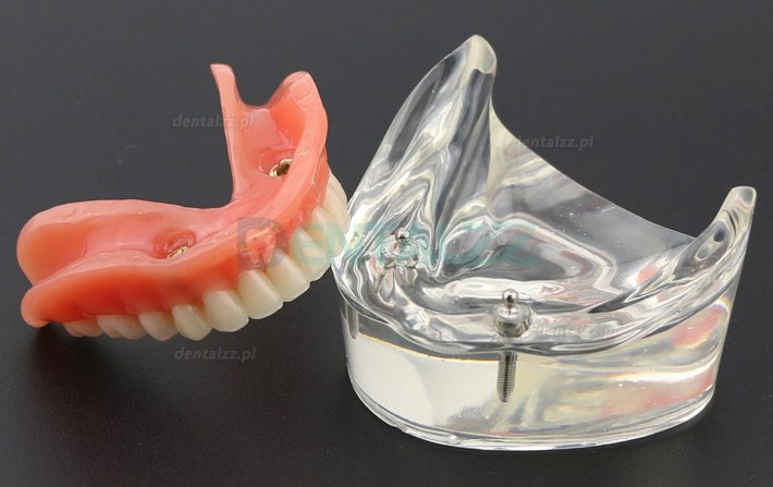 Model zębów dentystycznych Overdenture Inferor z 2 implantami Badanie modelu demonstracyjnego 6002 01