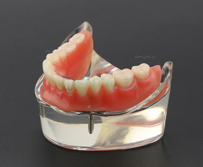 Model zębów dentystycznych Overdenture Inferor z 2 implantami Badanie modelu demonstracyjnego 6002 01