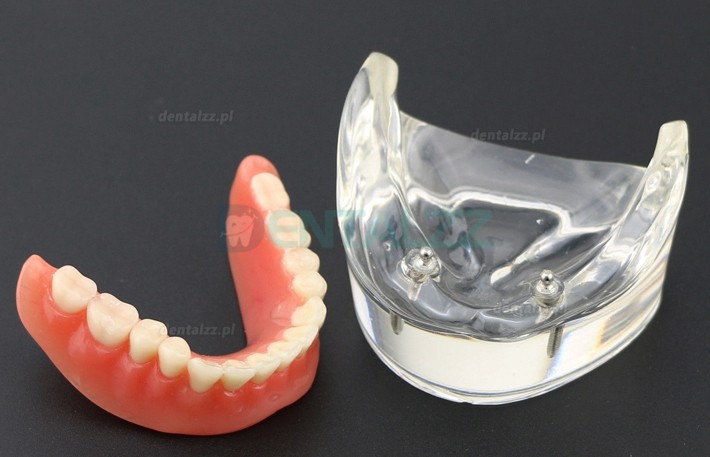 Model zębów dentystycznych Overdenture Inferor z 2 implantami Badanie modelu demonstracyjnego 6002 01