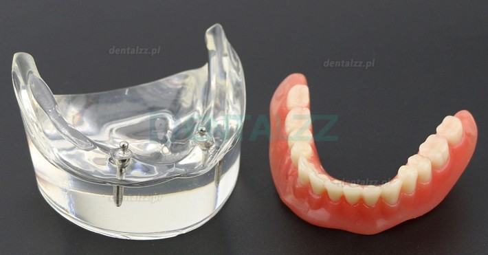 Model zębów dentystycznych Overdenture Inferor z 2 implantami Badanie modelu demonstracyjnego 6002 01