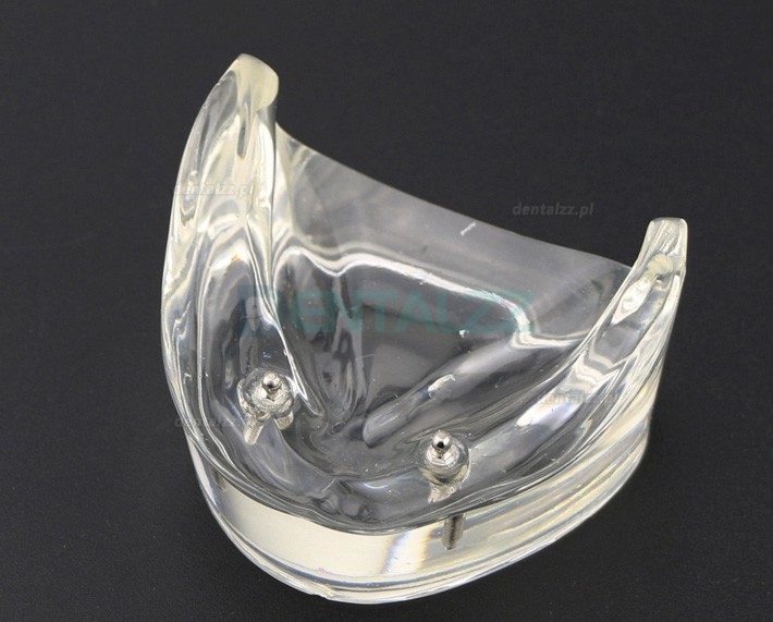 Model zębów dentystycznych Overdenture Inferor z 2 implantami Badanie modelu demonstracyjnego 6002 01