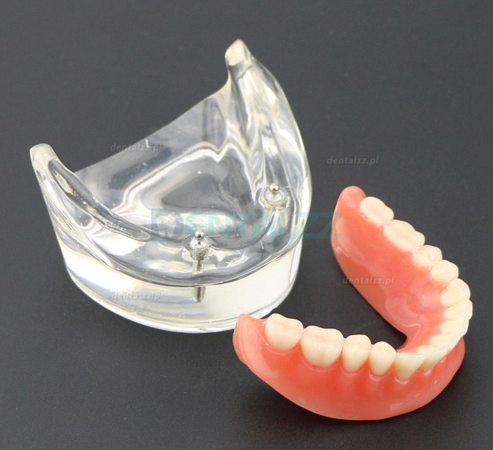 Model zębów dentystycznych Overdenture Inferor z 2 implantami Badanie modelu demonstracyjnego 6002 01