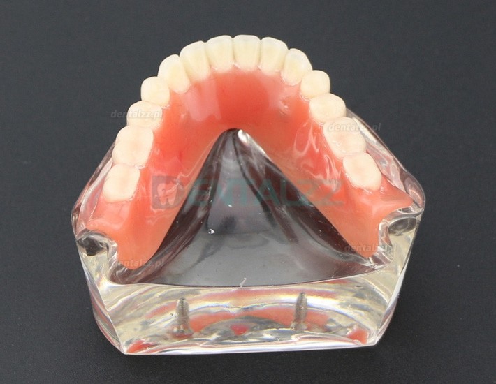 Model zębów dentystycznych Overdenture Inferor z 2 implantami Badanie modelu demonstracyjnego 6002 01