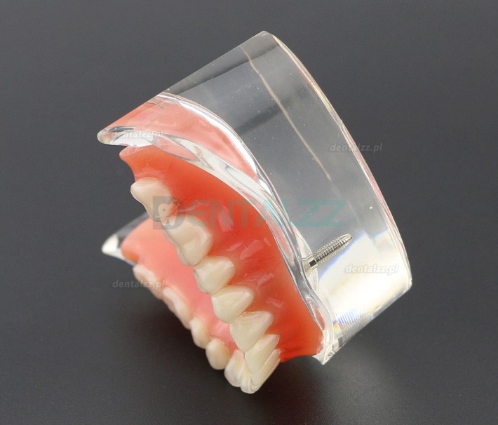 Model zębów dentystycznych Overdenture Inferor z 2 implantami Badanie modelu demonstracyjnego 6002 01