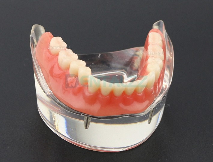 Model zębów dentystycznych Overdenture Inferor z 2 implantami Badanie modelu demonstracyjnego 6002 01