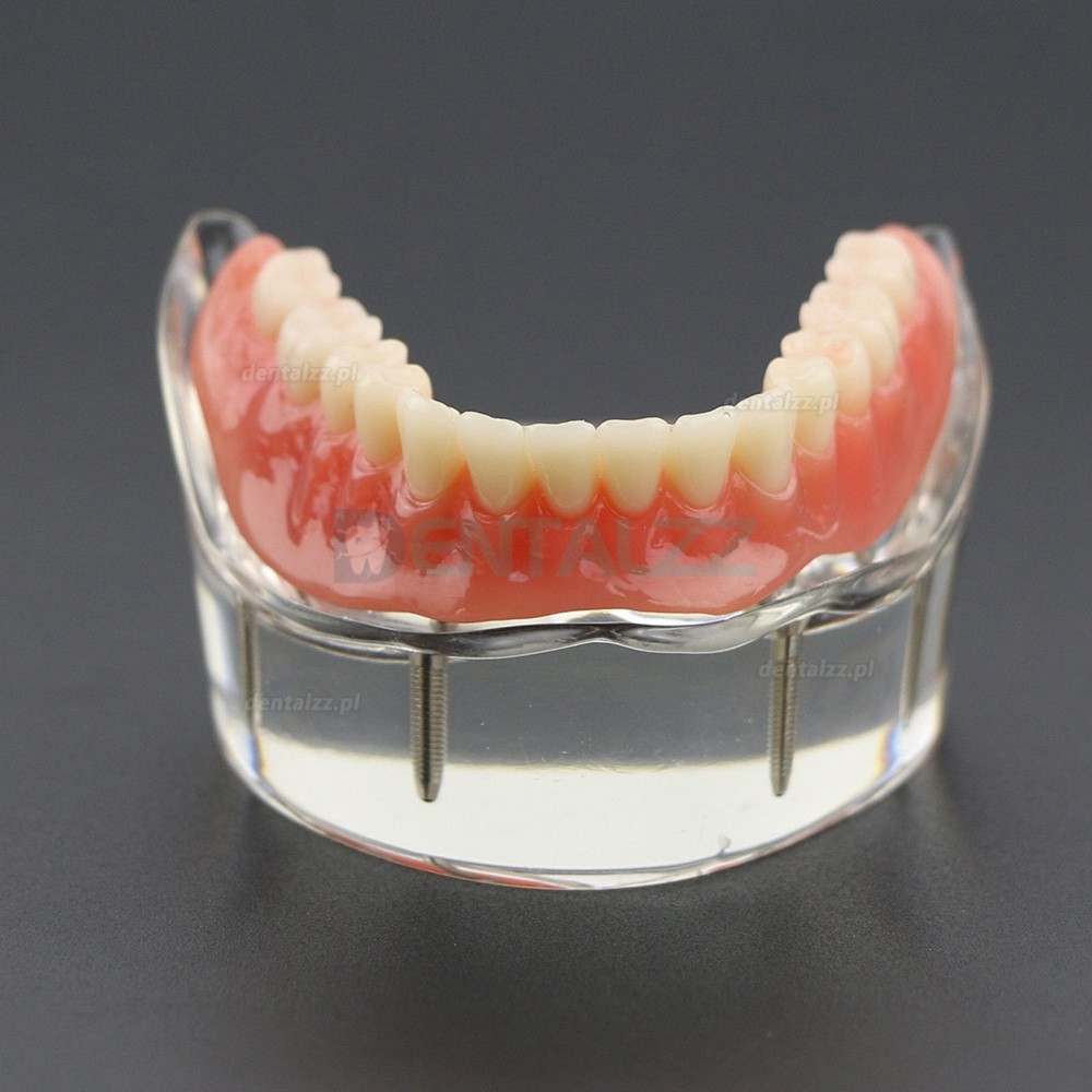 Model badania dentystycznego zębów dolnych 6002 02 Implanty Overdenture Inferior 4