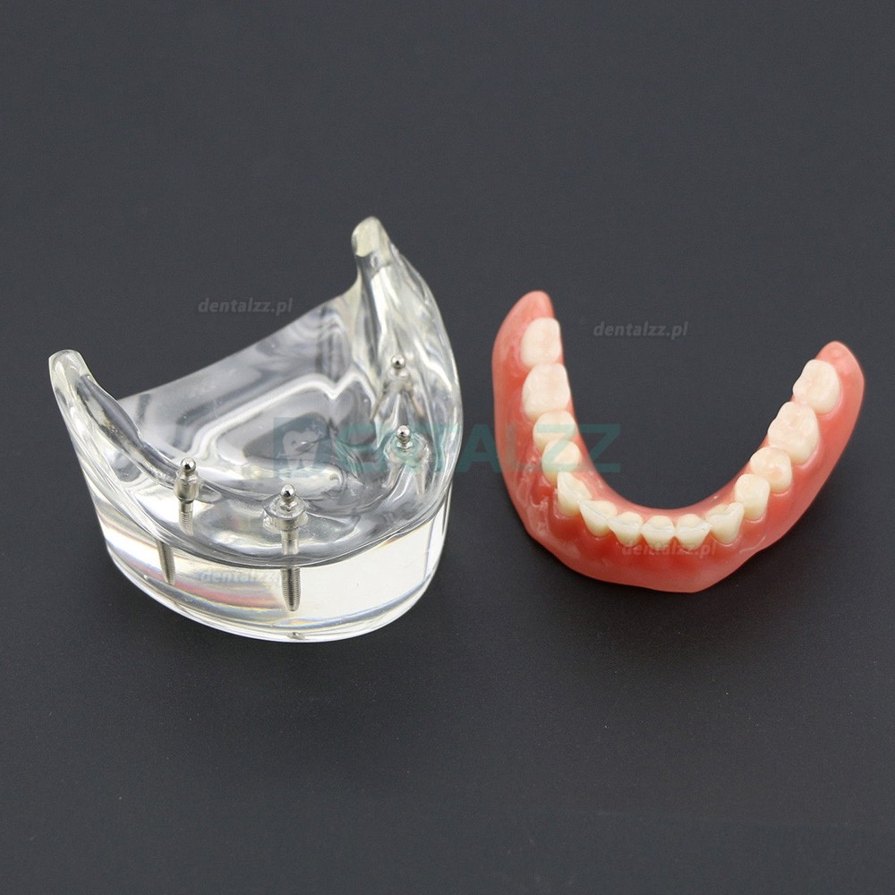 Model badania dentystycznego zębów dolnych 6002 02 Implanty Overdenture Inferior 4